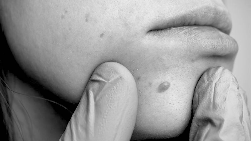 Cost of Skin Tags Removal Treatment in Oxford