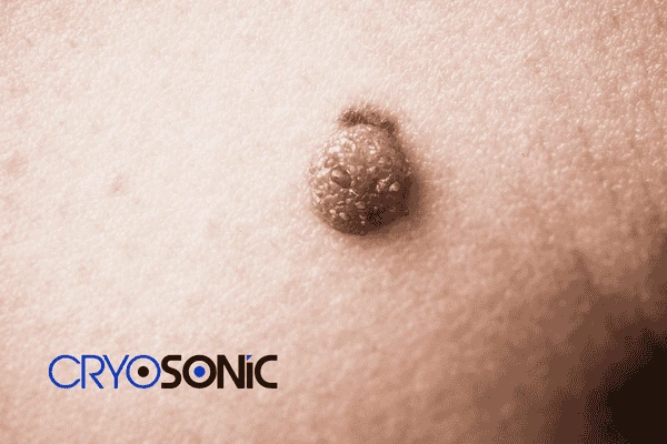 Looking for non surgical Dermatofibroma removal Oxford? Contact us today Oxford