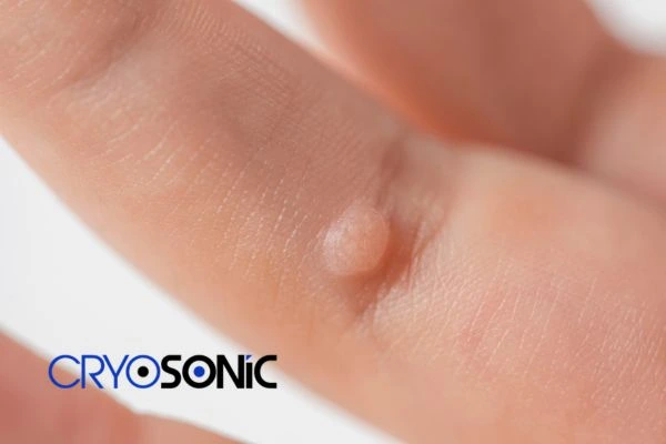 Contact Cryosonic today to learn more about us Oxford now! Oxford
