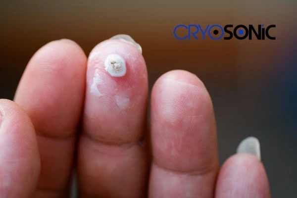 Learn more about us Oxford at Cryosonic. Book in today! Oxford