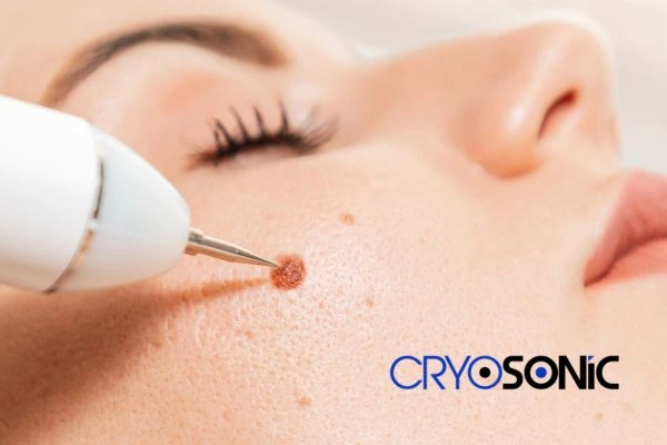 why choose us at Cryosonic for blemish removal? Find out more now Oxford