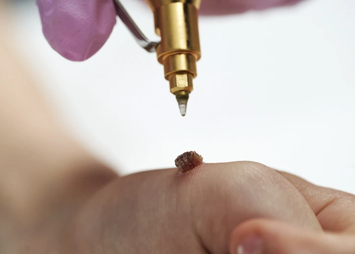Cryopen For Children Bristol Oxford