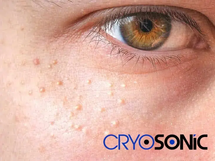Cryosonic&rsquo;s CryoPen Approach to Milia Removal Oxford Oxford