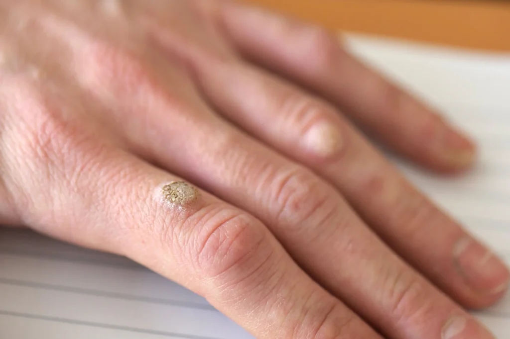 What to Expect After Warts Removal in Oxford Oxford