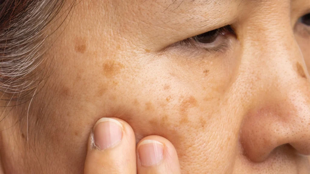 Seborrhoeic Keratosis Healing Process and Aftercare Advice Oxford