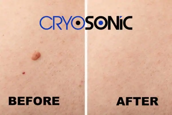 Before and after results of Cryofreeze Lesion Removal Service Oxford Oxford