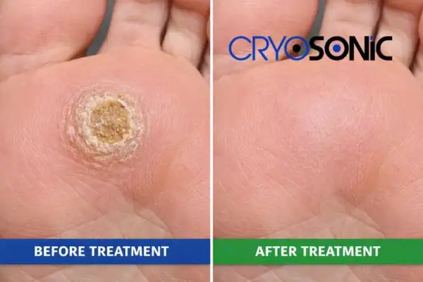 Before and after results of Porokeratosis Treatment Oxford Oxford