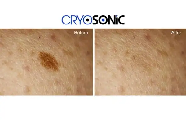 Before and after age spot removal Oxford Oxford