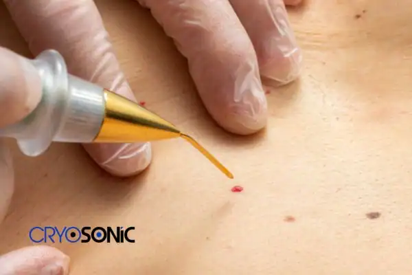 Image of cherry angioma removal Oxford Oxford