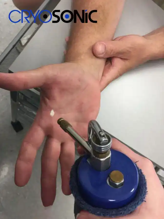 Temperature Differences: OTC vs Medical-Grade Cryotherapy Oxford